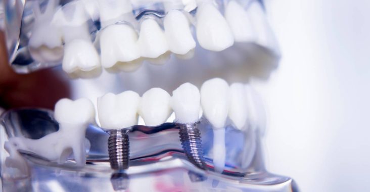 Proces implantacji zębów w Szczecinie